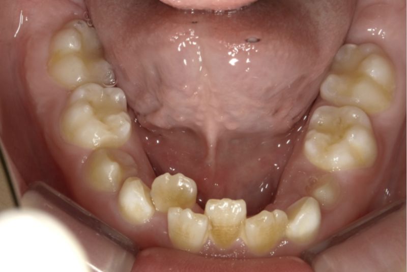 永久歯が重なって生えてきた
