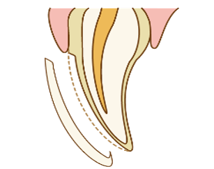 ラミネートべニア