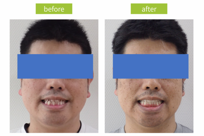 治療前治療後写真