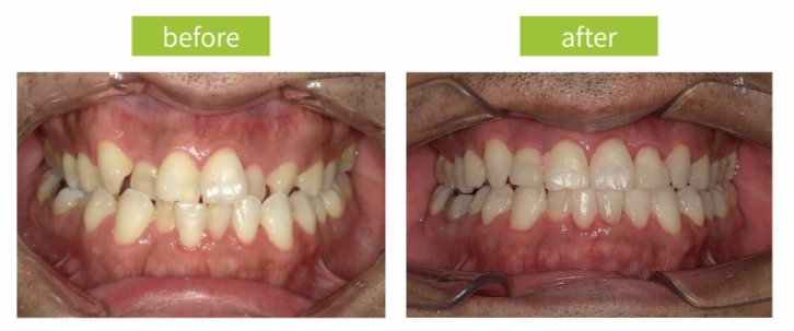 治療前治療後写真