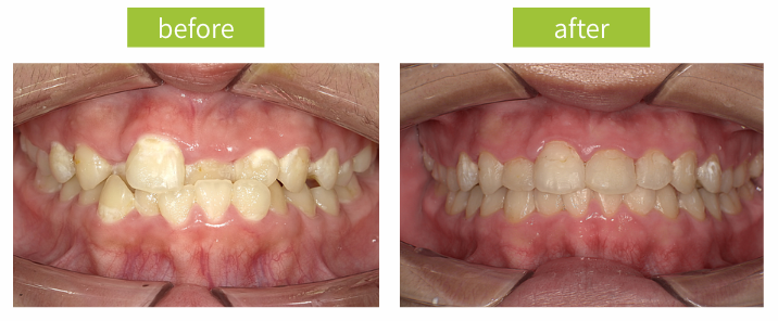 治療前治療後写真