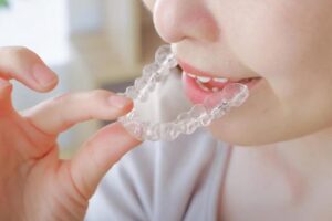 マウスピース矯正をはめる女性