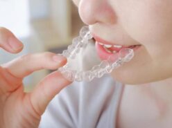 マウスピース矯正をはめる女性