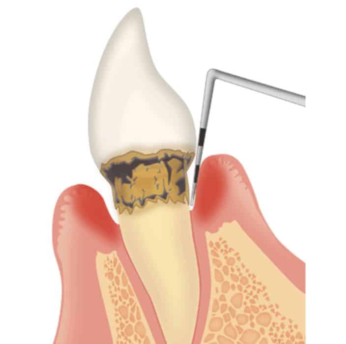 歯周病がどれぐらい進行しているかを診断する検査
