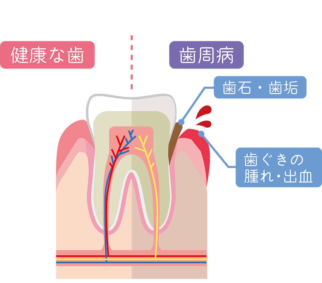細菌が、歯を支えている骨を溶かします