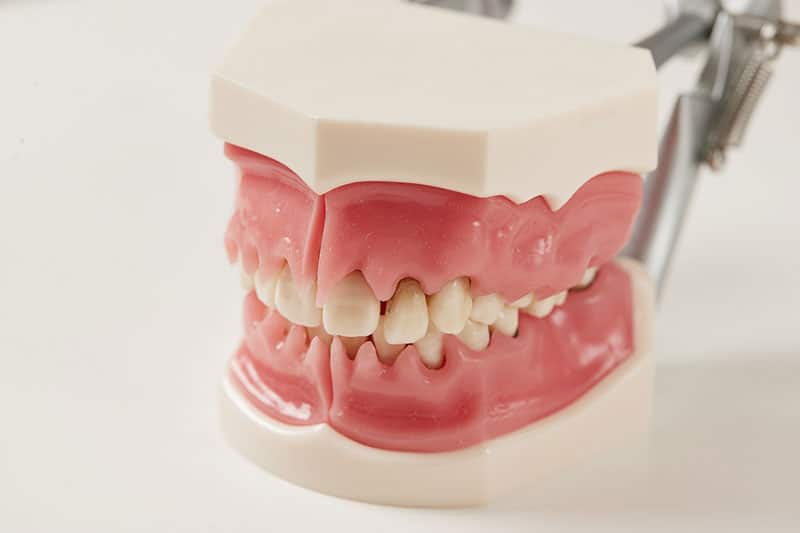 歯周病の模型を使った説明